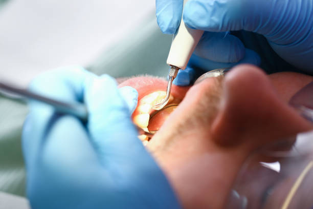 Best Dentist for Tooth Abscess  in Pine Lakes, FL